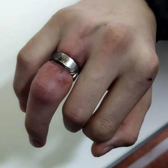 В Карагандинской области спасатели при помощи инструментов сняли кольцо с пальца подростка 